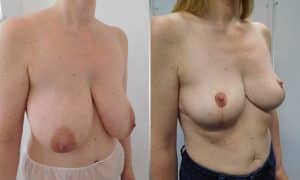 Before and After
